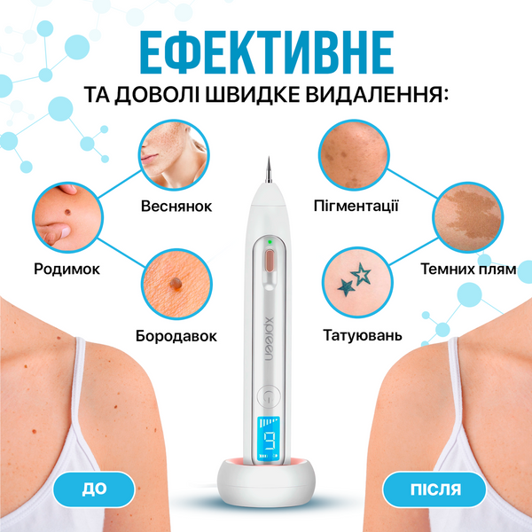 Електрокоагулятор прилад для видалення папілом бородавок плазмова ручка Plasma Pen XPREEN 051 Білий PP-051_278 фото